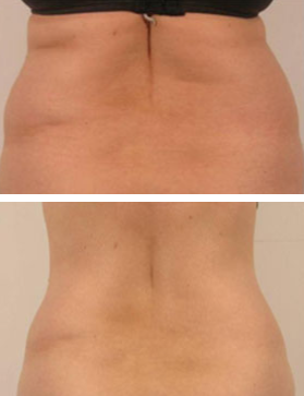 Body contouring