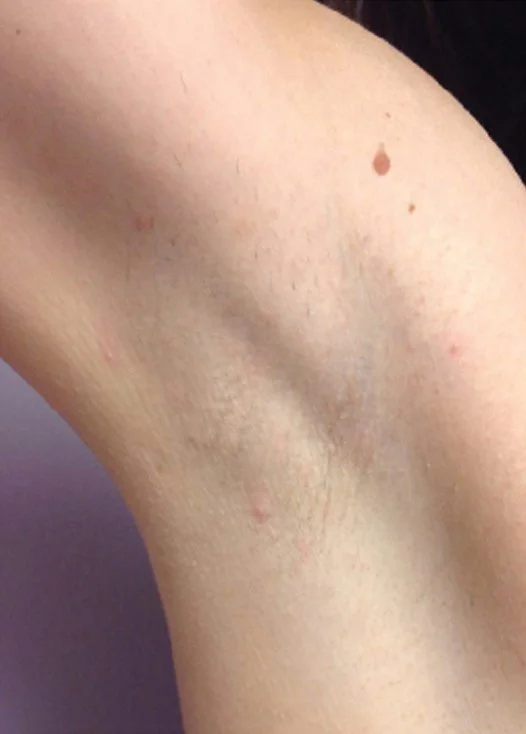 Laser hair removal after
