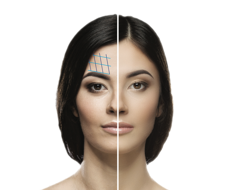 Brow lift
