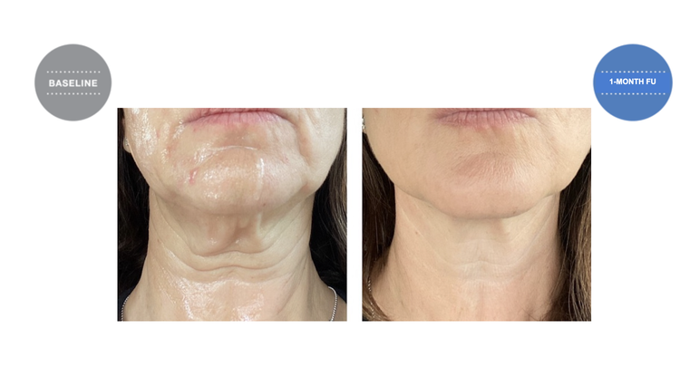 Neck and chin