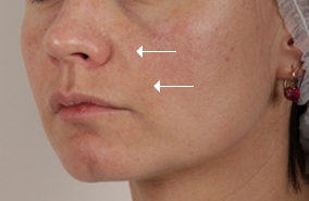 Facial rejuvenation