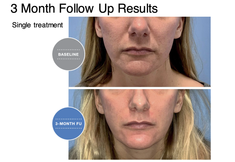 Face lifting