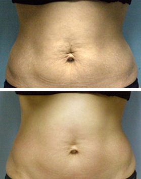 Body contouring