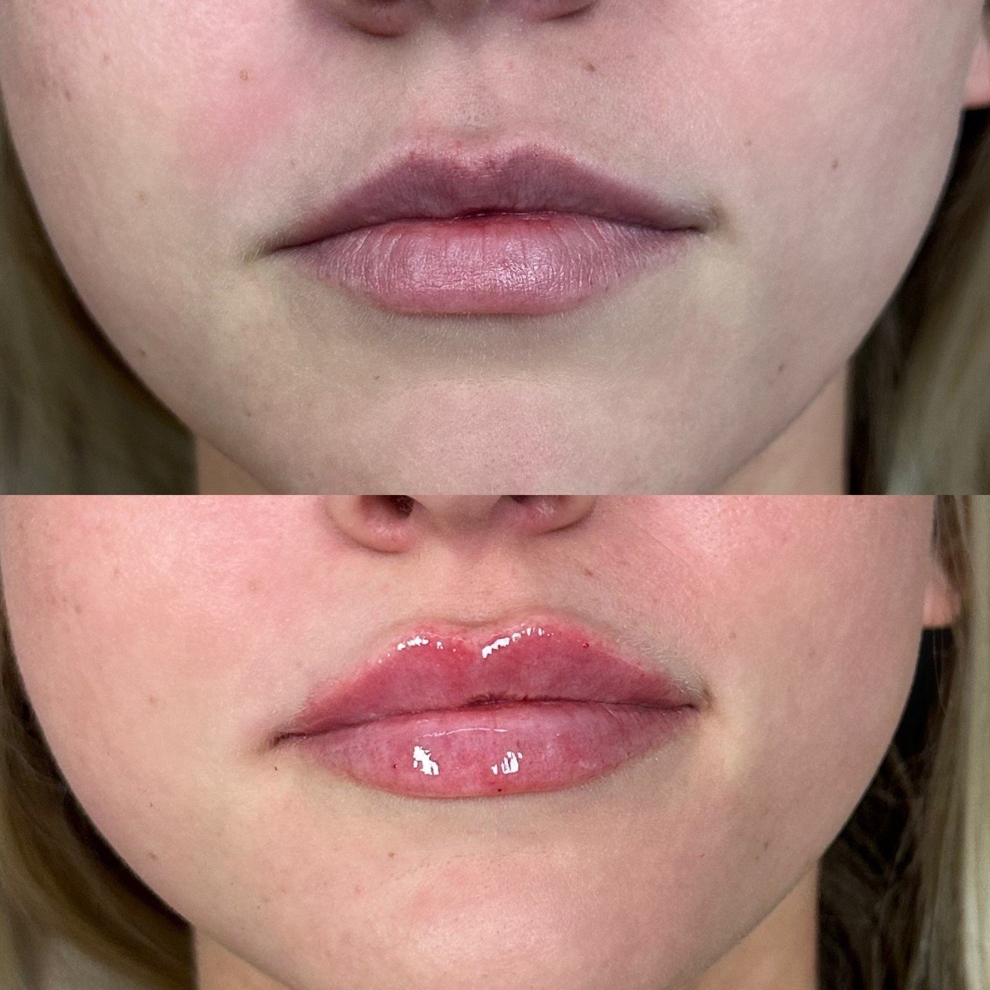 Subtle changes make all the difference! ⁠
⁠
This beautiful client wanted to enhance her natural shape and add a little more plump to her lips! The results still maintain her natural shape with just a little extra volume!⁠
⁠
Ready to enhance your feat