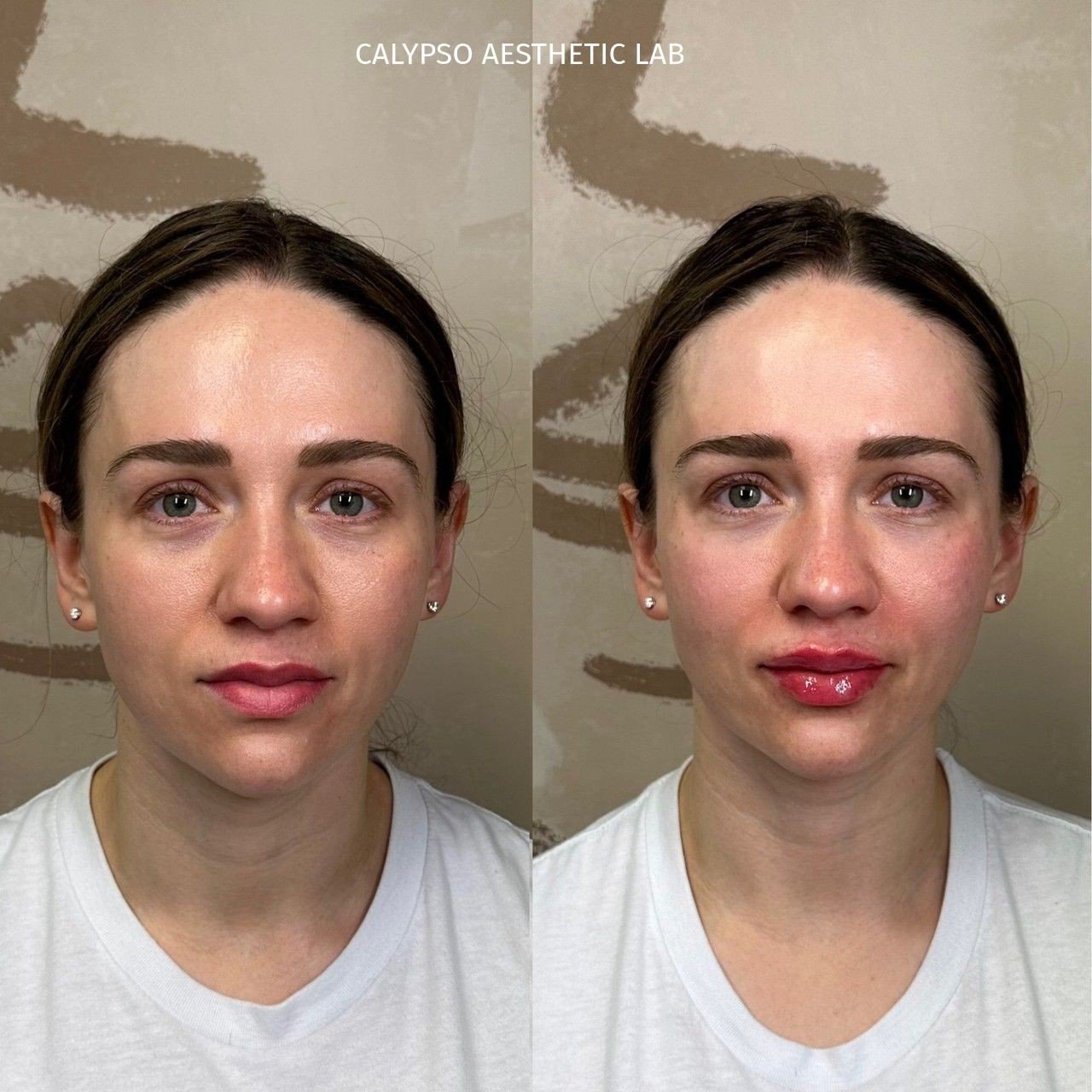 A little full face enhancement on this beauty!!⁠
⁠
This patient had her lips, mid-cheek, naso-labial folds, and tear troughs done at this appointment. A little enhancement goes a long way!⁠
⁠
Injecting in multiple areas helps create balance + overall