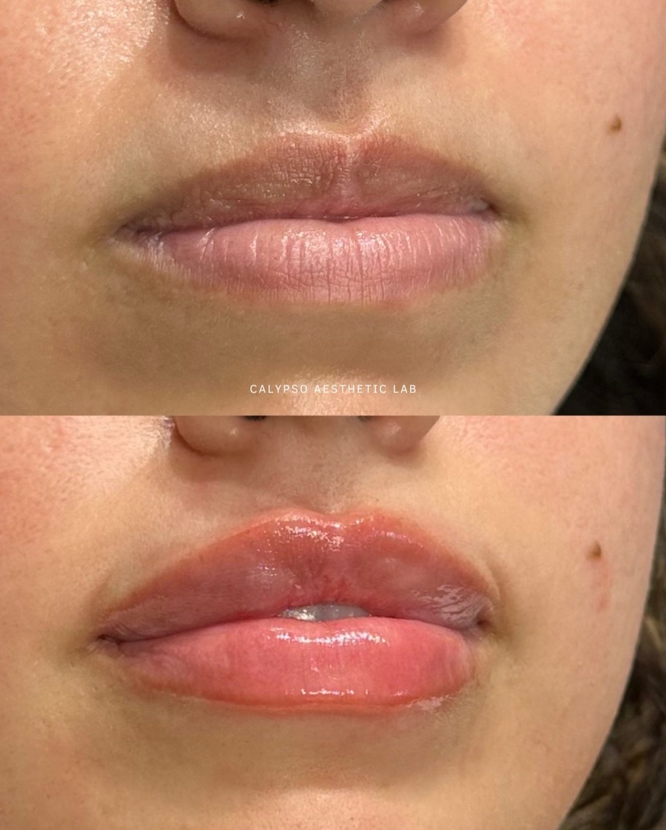 Lip filler isn&rsquo;t just about increasing volume. It&rsquo;s about refining shape, restoring balance, and adding hydration. 💧

This patient wanted to focus on soft fullness and we were able to give her lips a naturally hydrated look. 🤍

Get the 