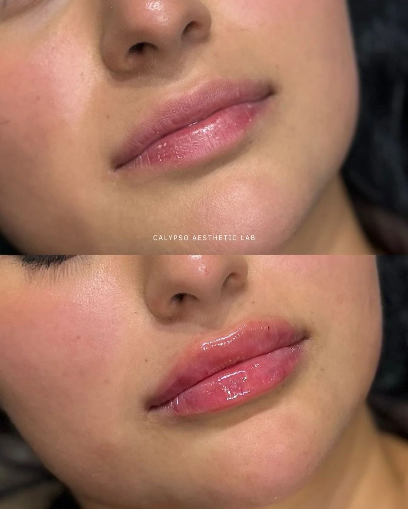 Thinking about lip filler? 💋 Let&rsquo;s answer a few of the most common questions we hear:

💉 Will it look natural? Yes! When done correctly, filler enhances your shape + volume while keeping proportions balanced.
💉 How long does it last? Typical