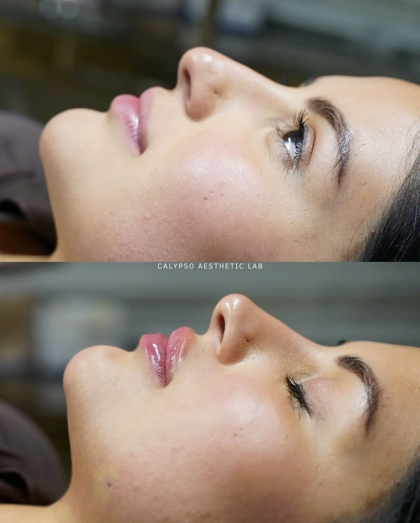 These results speak for themselves. ✨ 

For this patient, (tag britt) focused on her nose, lips, and chin shadow to bring harmony to her lower face. Subtle adjustments in multiple areas can make a world of difference &mdash; enhancing proportions, so