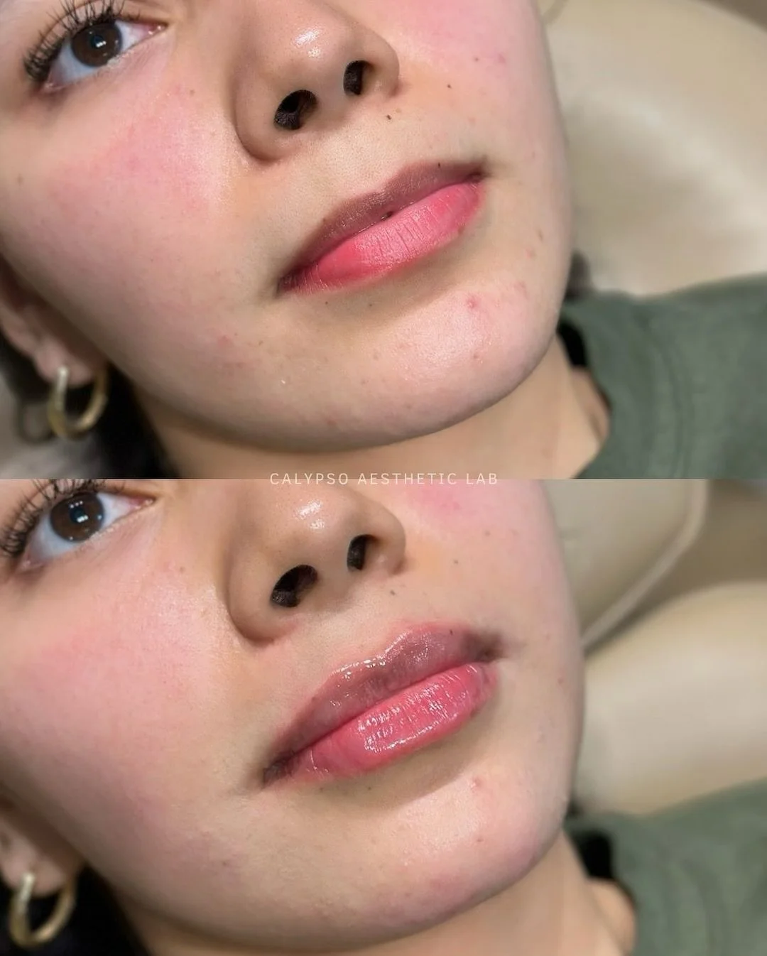 A reminder that there&rsquo;s no one-size-fits-all when it comes to #lipfiller. 

Each of these results reflects a completely personalized approach - taking into account each patient&rsquo;s unique anatomy, proportions, and goals. From subtle hydrati