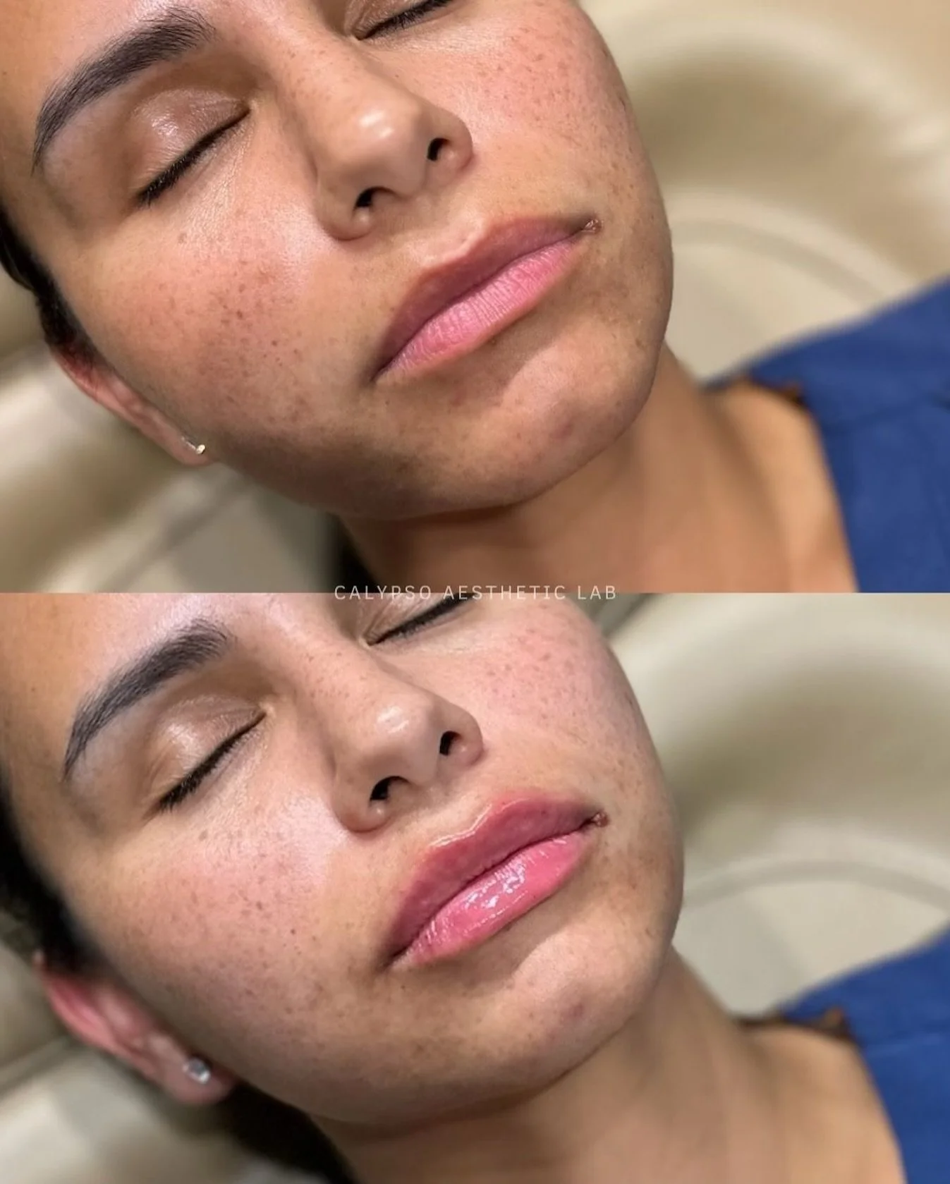 Fresh off the needle 💉 @thebombshellpa restored hydration and enhanced her lip shape for a subtle refresh. 

#lipfillerdallas #dallasinjector #galderma #naturallipfiller #lipgoals