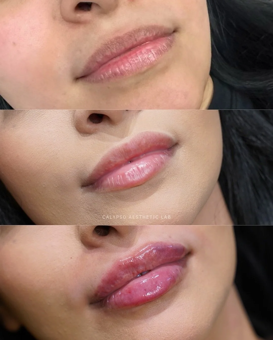 These results were achieved over time, using two syringes to gradually expand the tissue, enhance structure, and create a shape that looks full, balanced, and natural to her anatomy.

Filler works as a tissue expander, which means your lips need time