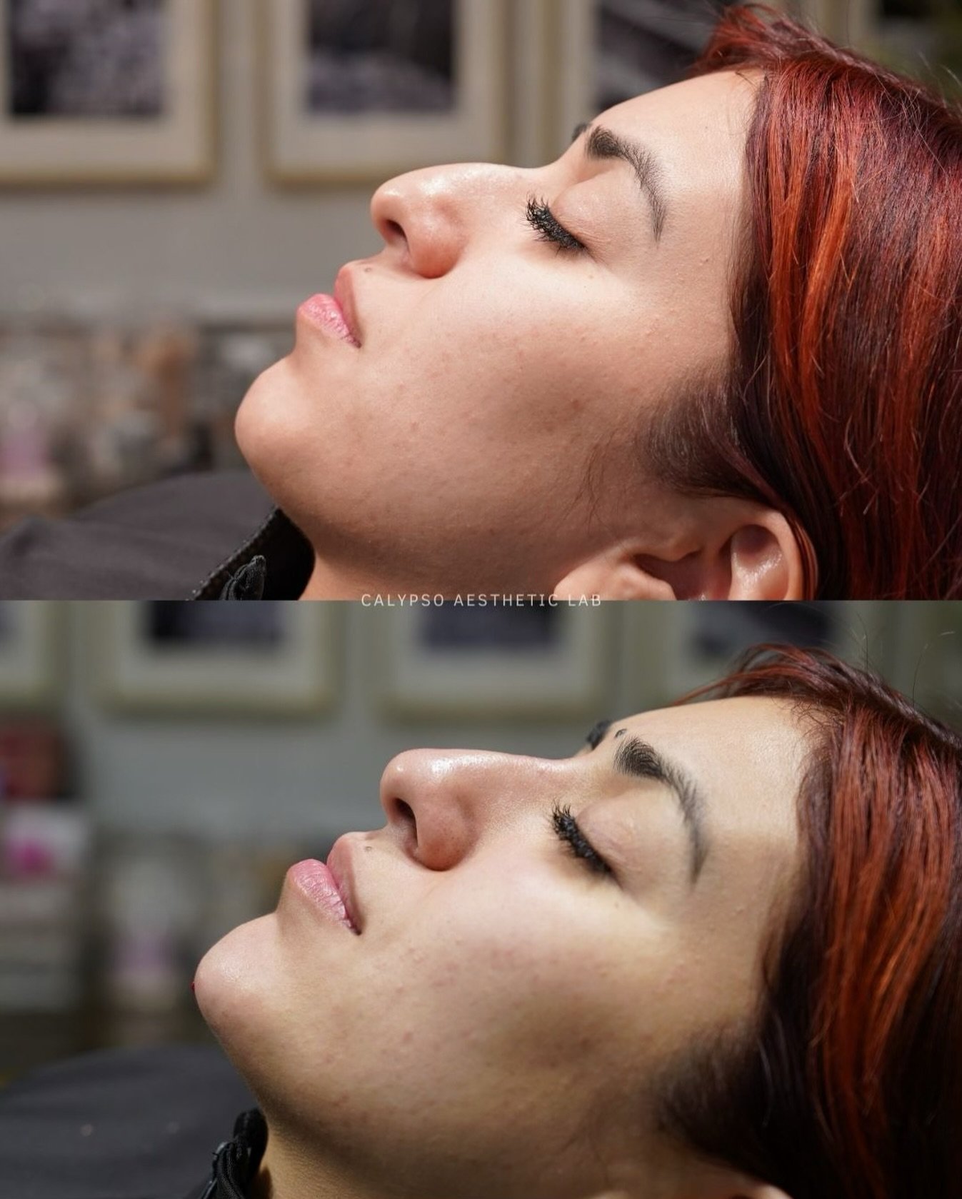 Subtle changes can make the biggest impact.

When strategically placed, nose filler helps to smooth bumps, refine your profile, and create a more balanced shape &mdash; all without surgery.

Not everyone is a candidate for this treatment so we encour