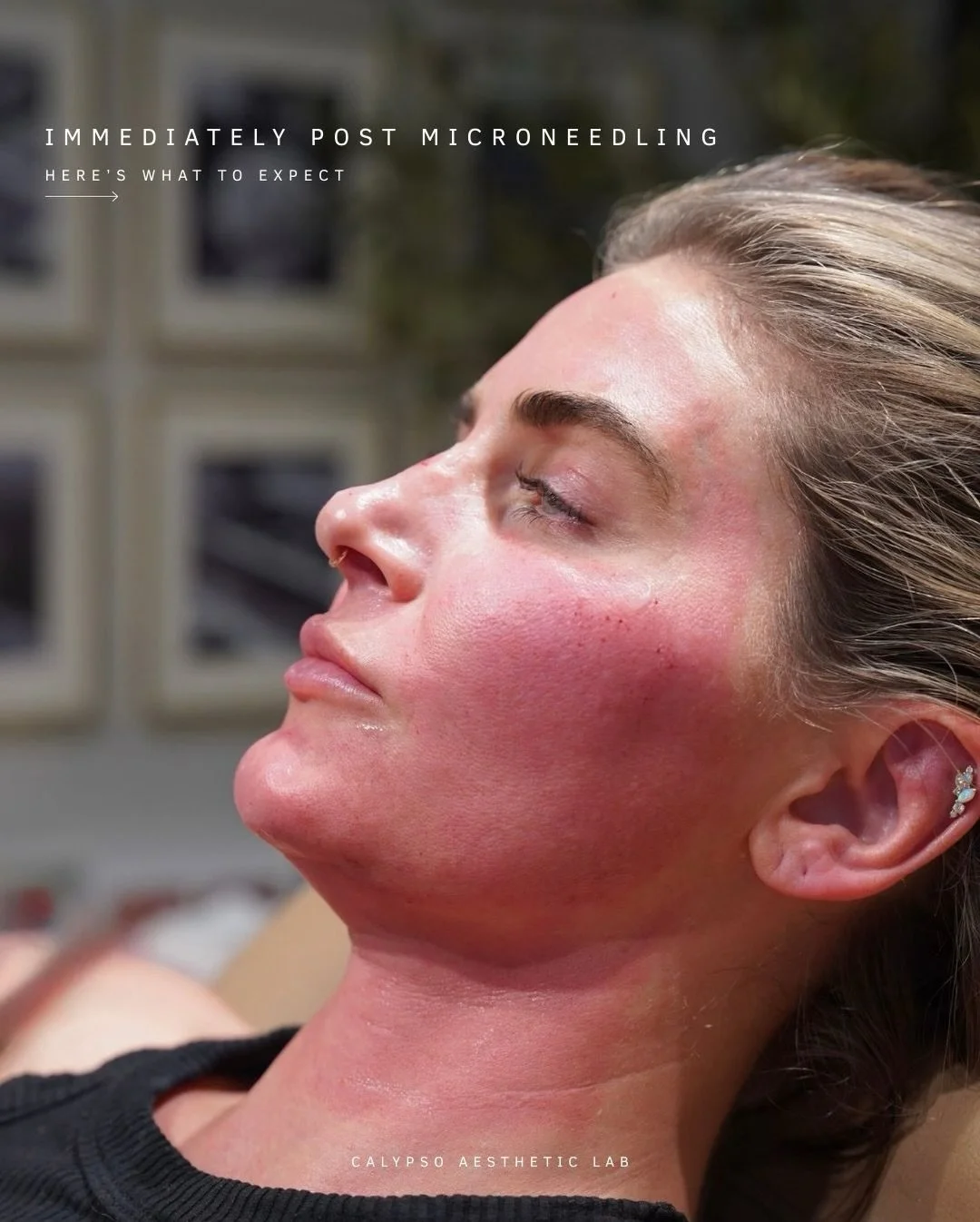 Microneedling works by triggering your skin&rsquo;s natural healing response to build collagen and elastin, the structural proteins that keep skin healthy and supple. ✨

During and immediately after treatment you may experience warmth, redness, and a