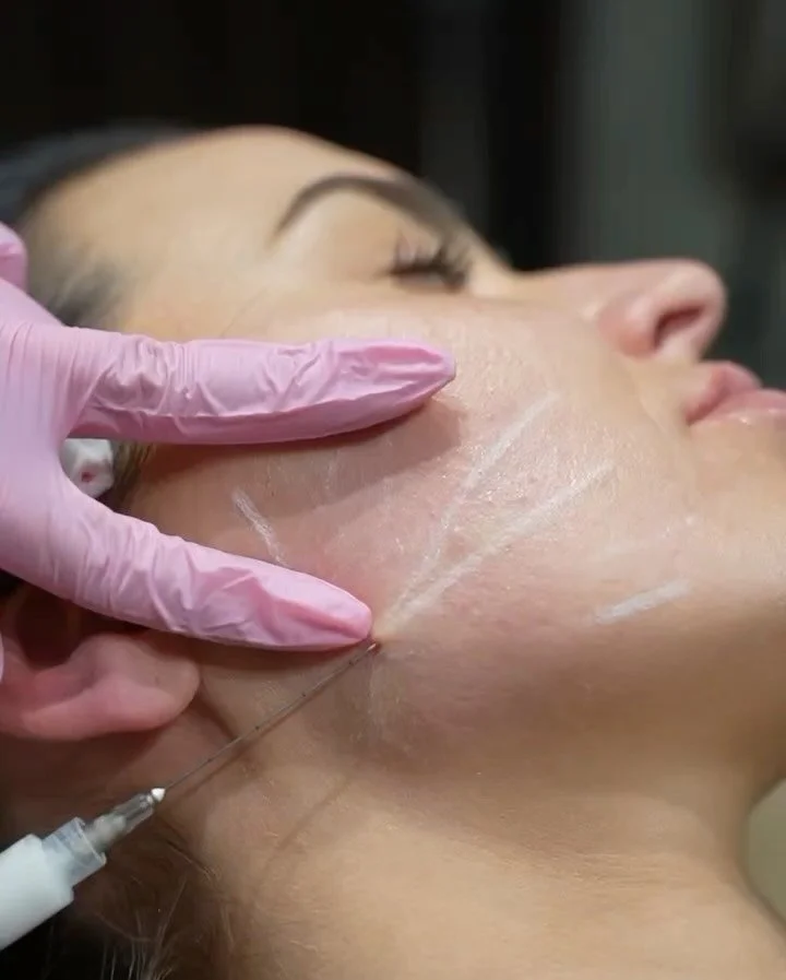 Radiesse delivers results in two phases, which is what sets it apart from other injectables. 

Phase one: the gel carrier provides immediate structural support, helping restore contour and improve firmness right away.

Phase two: as the gel is natura