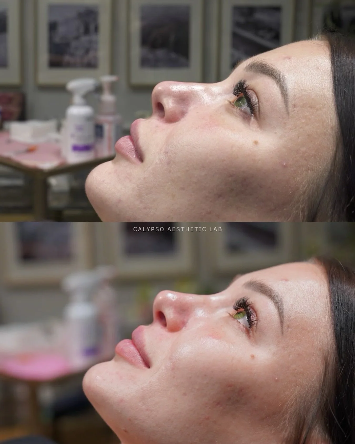 A non-surgical rhinoplasty is all about restoring balance and creating harmony. ✨

By strategically placing filler, we can smooth bumps, refine the bridge and lift her tip, instantly and without surgery or any downtime. 

Consultations are key for sa