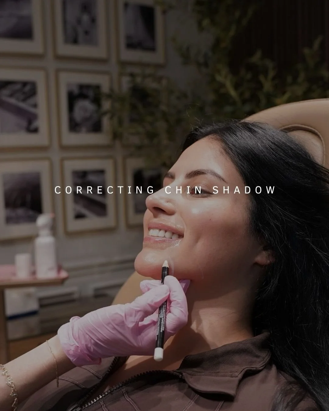 That shadowing or indentation along the sides of your chin is referred to as chin shadow and it&rsquo;s often caused by volume loss, bone structure, muscle pull, or skin laxity, not pigmentation, that creates the illusion of a shadow. 

Because it&rs