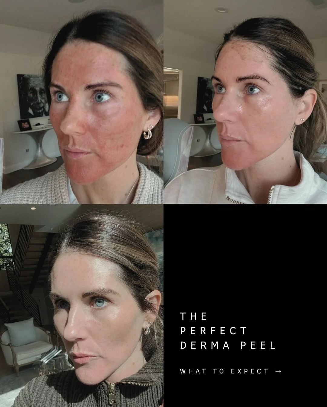 The Perfect Derma Peel is one of our go-to treatments when skin needs a real reset &mdash; not just a temporary glow. 🤍

This medium-depth peel works by accelerating cellular turnover, helping shed damaged skin and reveal a brighter, smoother, more 