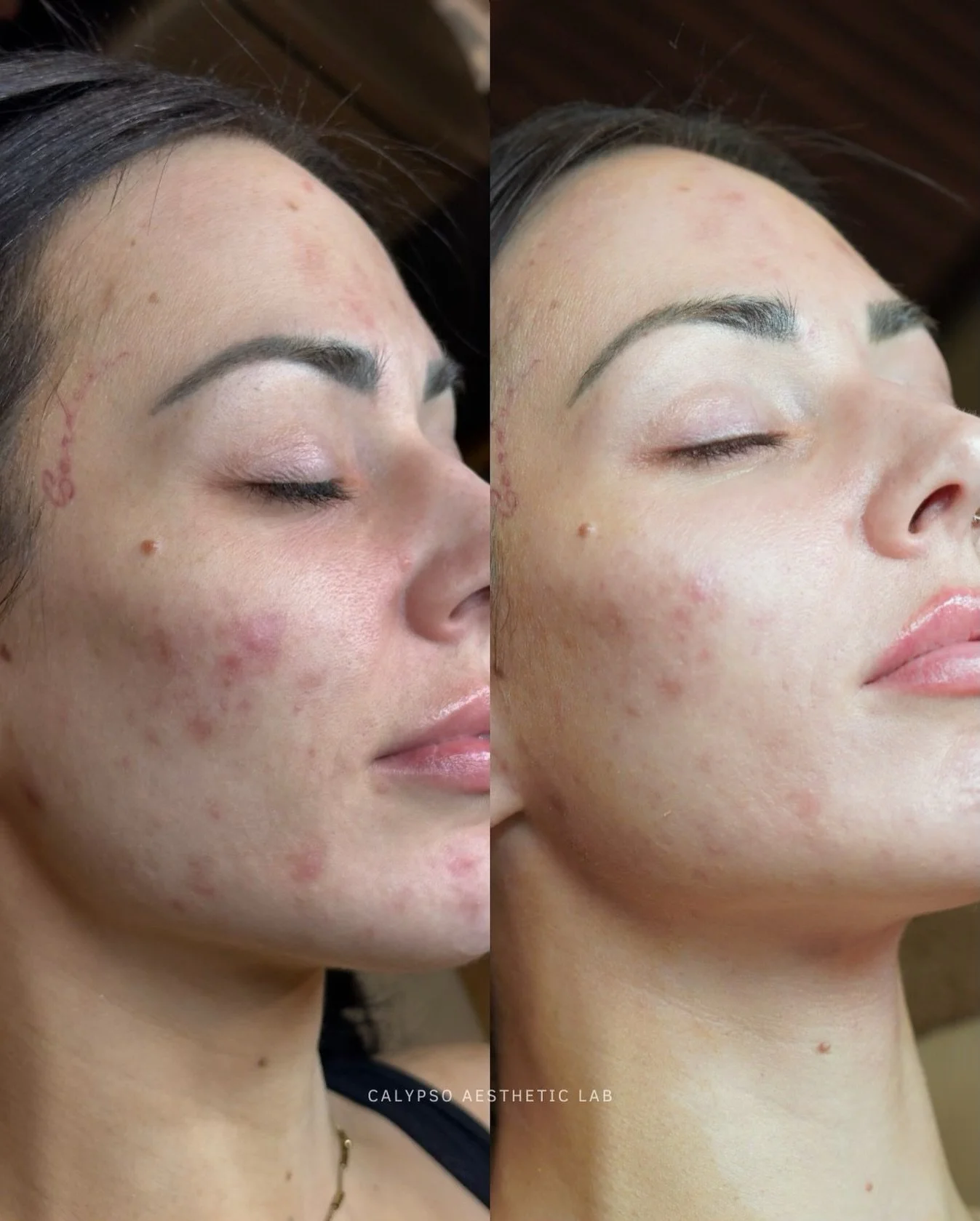 Just 7 days after the Perfect Derma Peel ✨

Redness and inflammation have already calmed, texture is smoother, and her overall skin tone looks noticeably more even. While this is just the beginning &mdash; and we&rsquo;ll be continuing with a series 