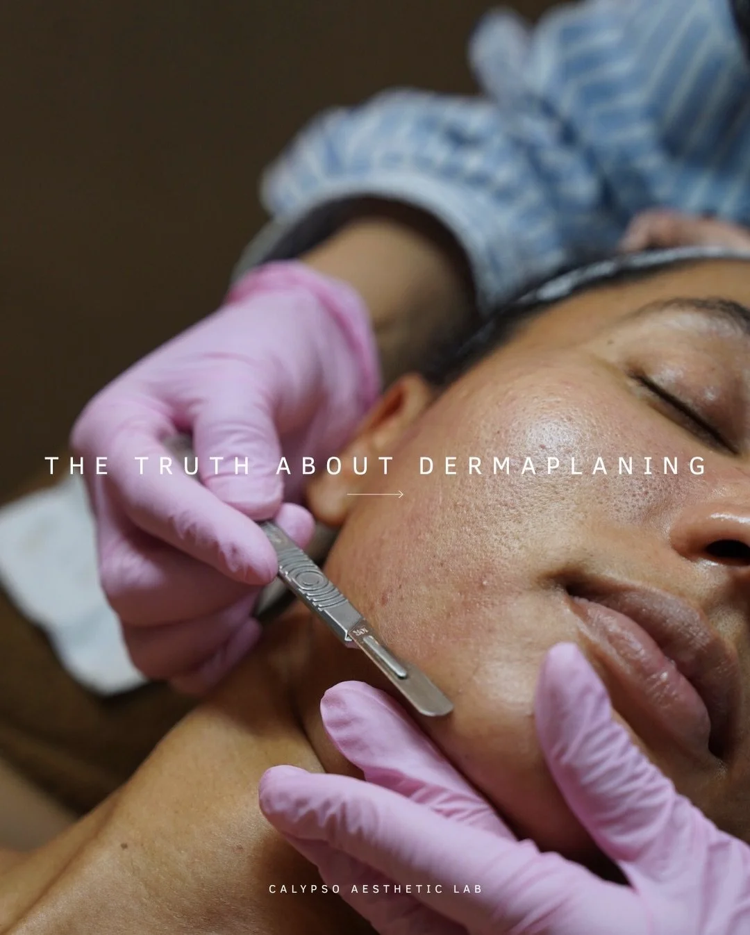 Dermaplaning isn&rsquo;t shaving &mdash; it&rsquo;s professional exfoliation. ✨

This treatment gently removes dead skin buildup and vellus hair (aka peach fuzz) to reveal smoother texture, brighter tone, and allows skincare to penetrate more effecti