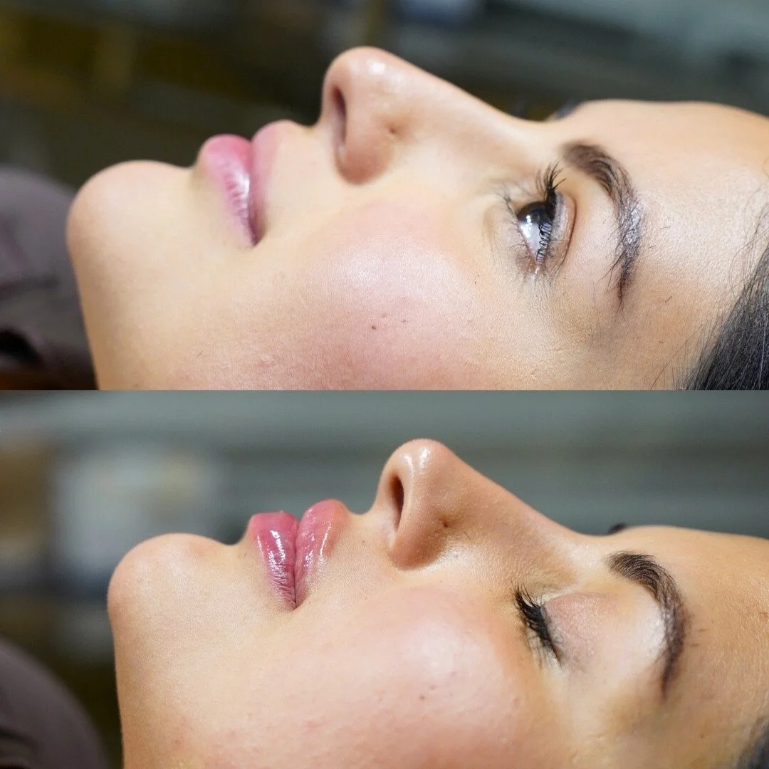 Comparison image of a woman's face before and after a cosmetic or skincare treatment, showing smoother skin and enhanced lips in the after photo.