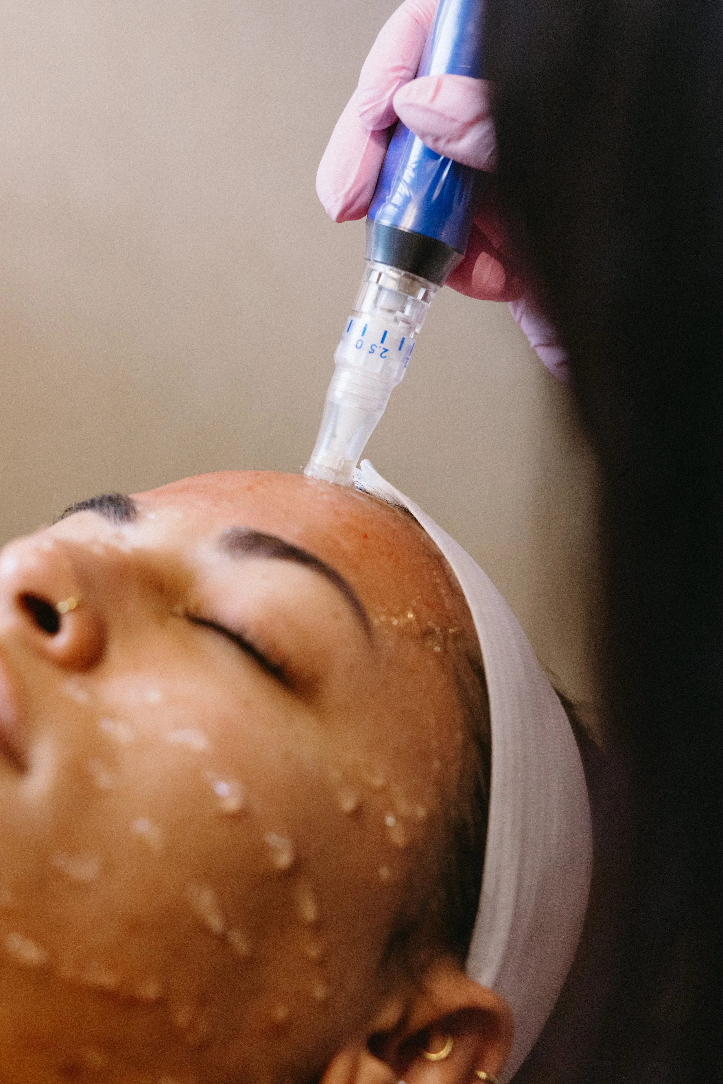 A person is receiving a facial treatment with a microneedling device on their face, lying with eyes closed, while a skincare professional wears gloves.