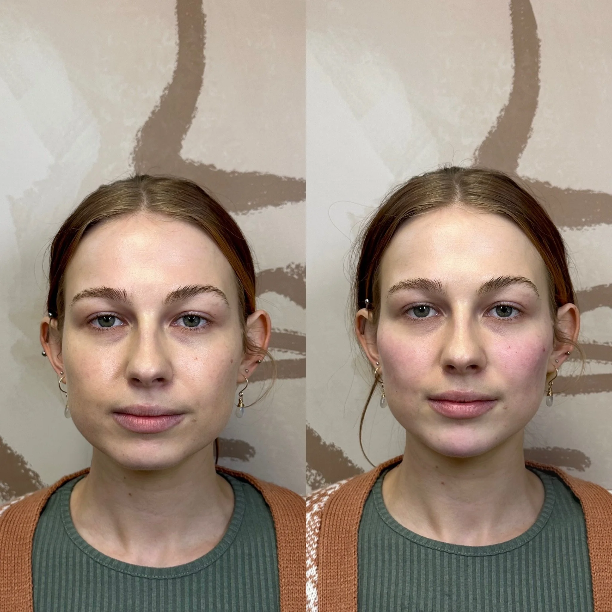 This before and after shows the power of facial balancing. This patient received cheek and chin filler leaving her with a more feminine appearing face.