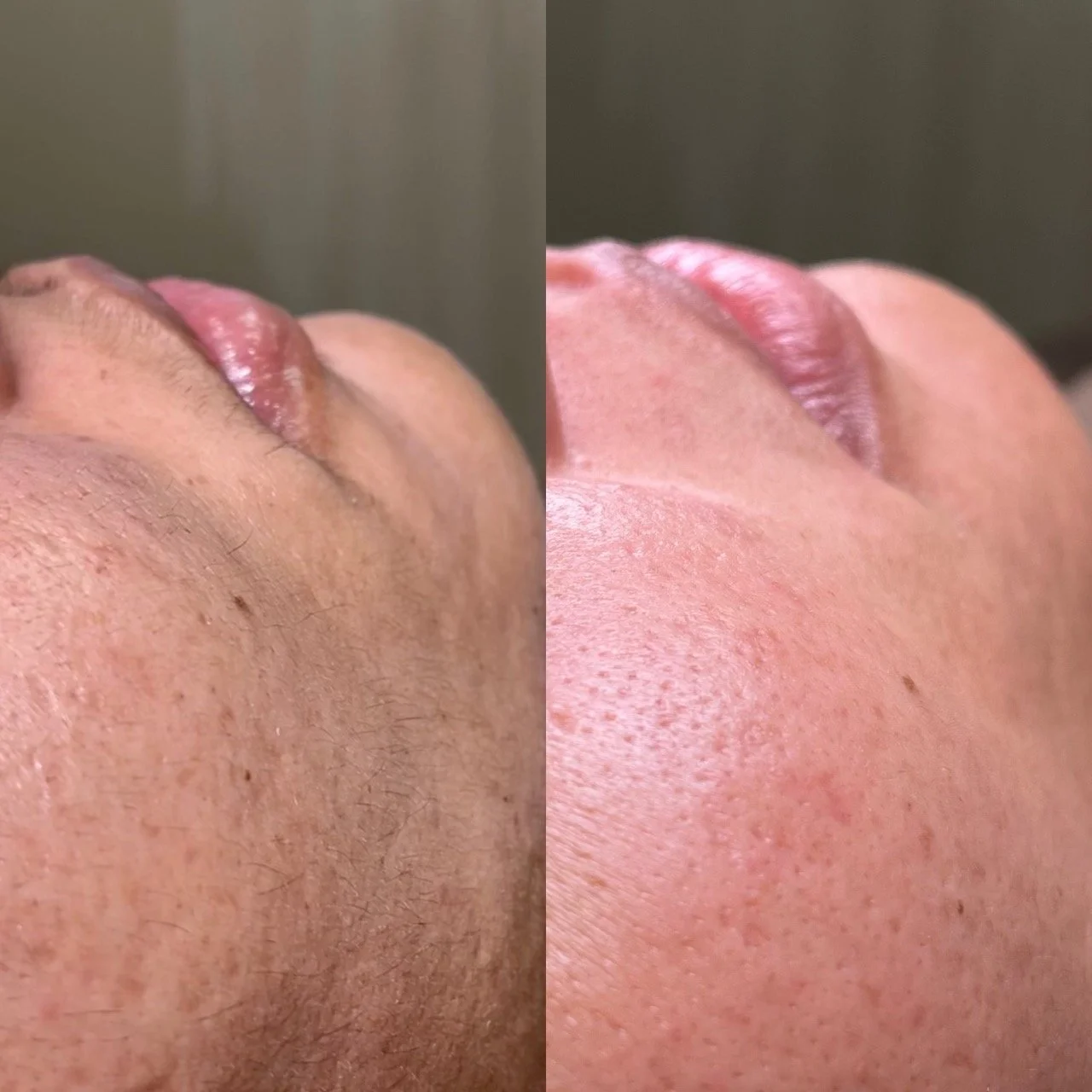 Close-up comparison of a person's face before and after skincare treatment, showing improved skin texture and reduced blemishes