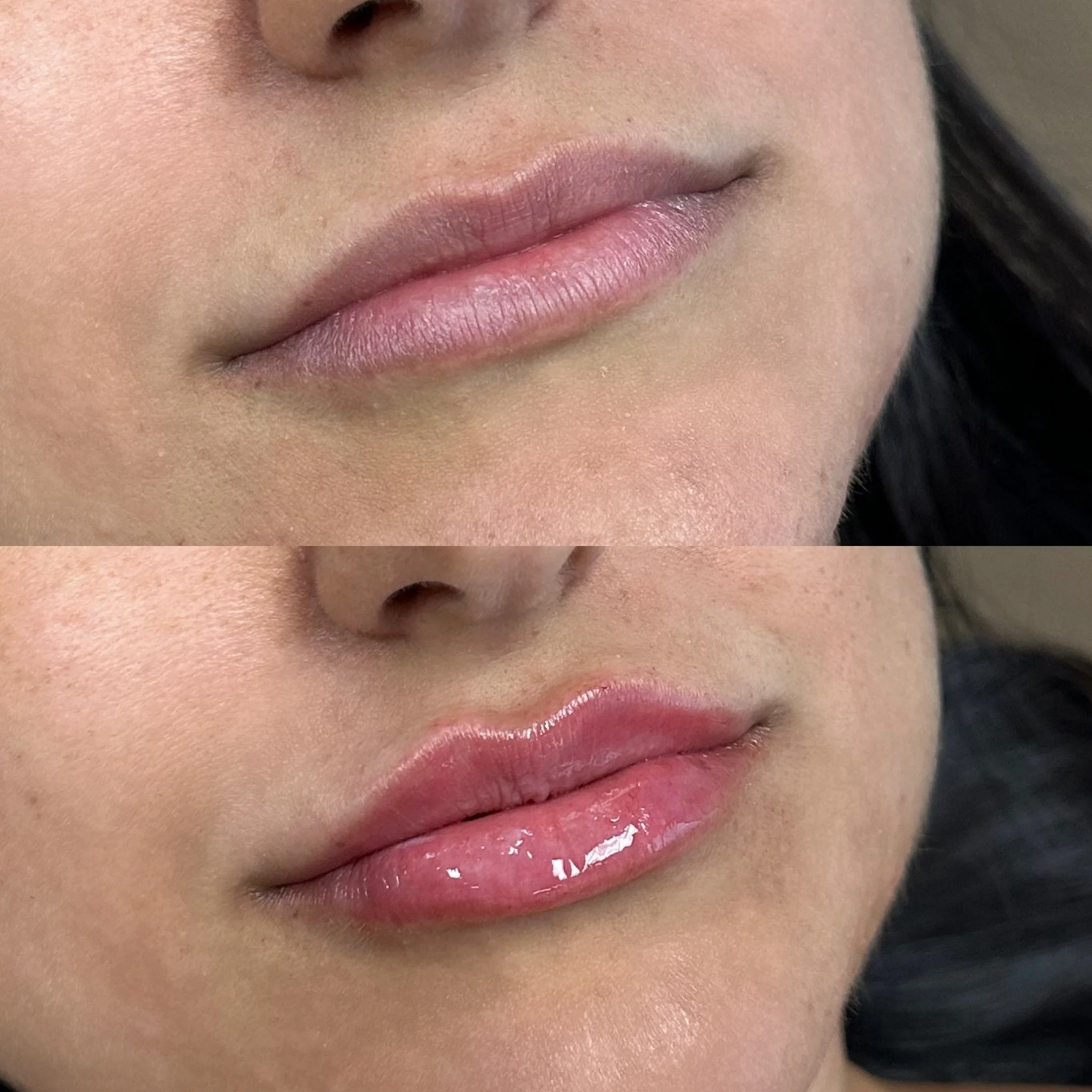 This before and after showcases how lip filler can be used for overall lip hydration while adding just the smallest of volume.