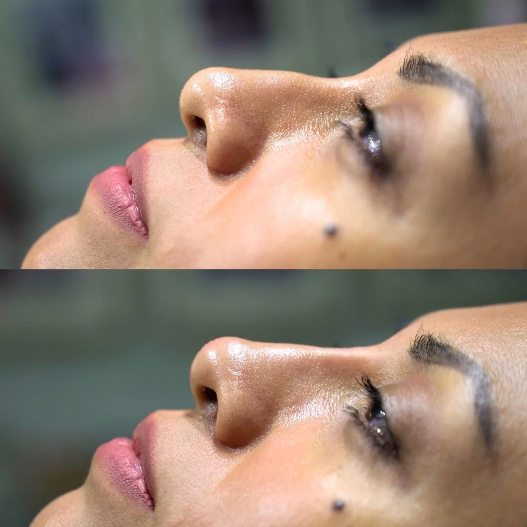 liquid nose job before and after.jpg