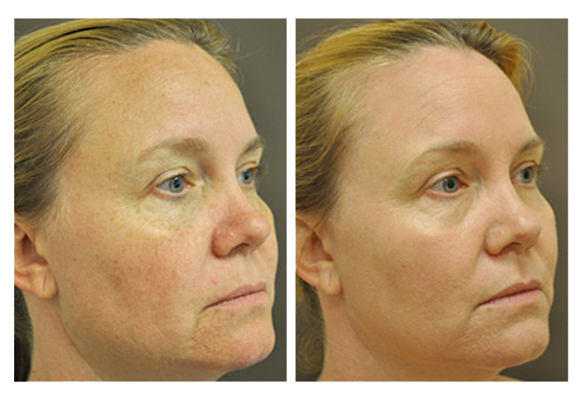 Woman skin before and after PixelPeel Treatment