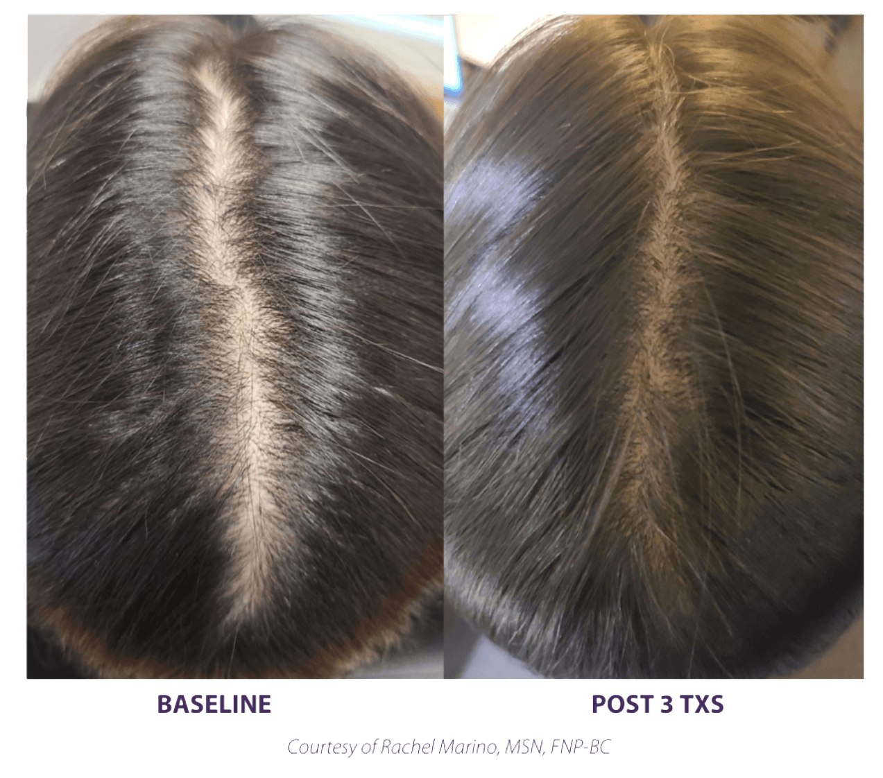TED results showing a wide part before treatment and a fuller head of hair post treatment