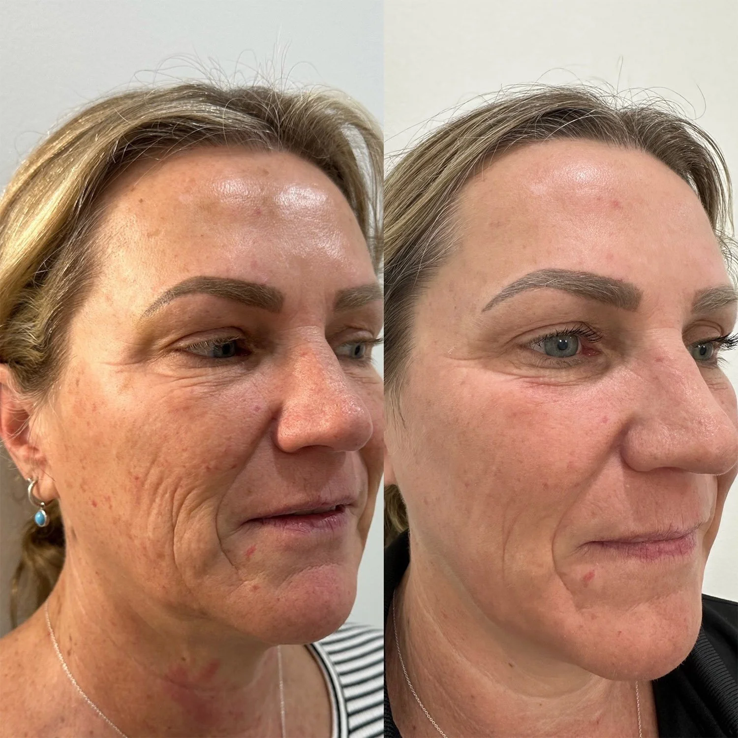 Before and after of woman's skin with less wrinkles and markings