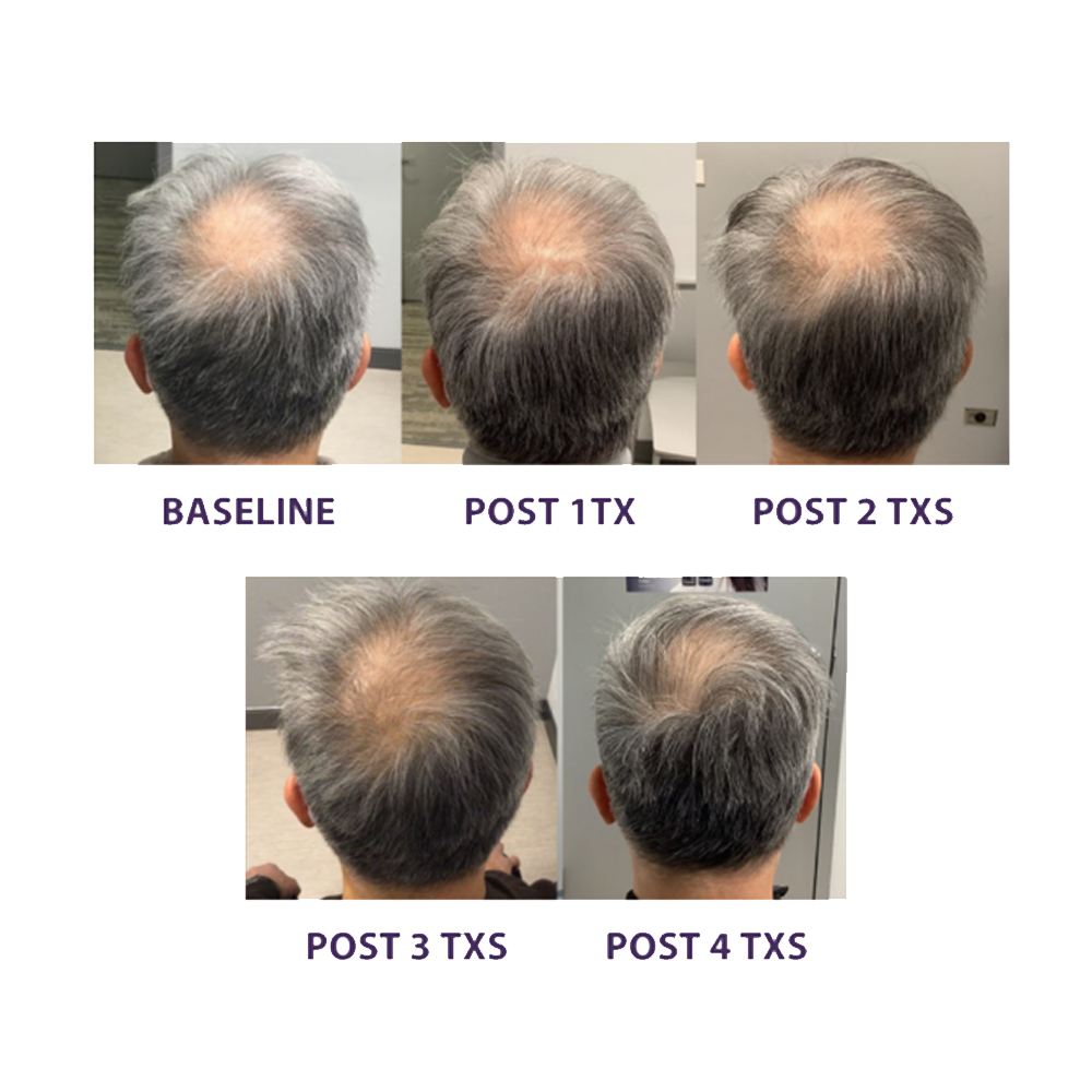 TED Results for a man with a bald spot showing progression through treatments