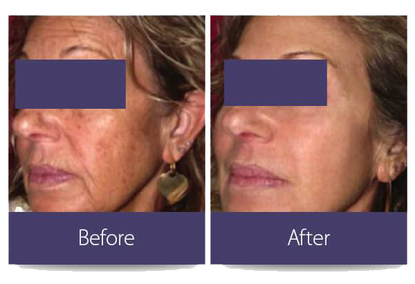 Incredible results of PixelPeel for older woman