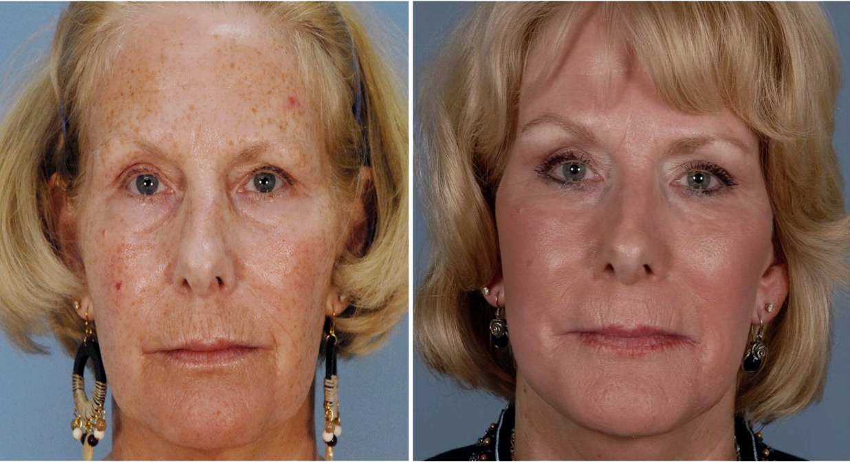 Older woman before and after PixelPeel treatment for smoother skin