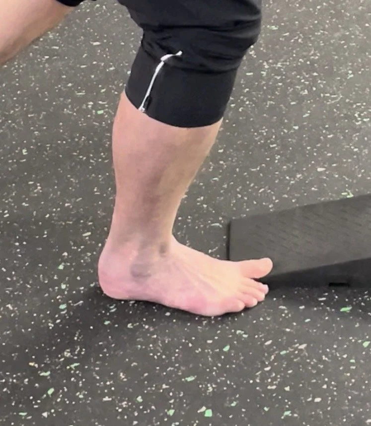 Beating Plantar Fasciitis: A Performance Physical Therapist's Playbook for Denver Athletes