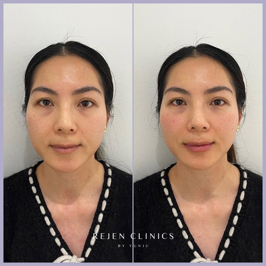 Why do I love natural yet elevated aesthetic?

I love and aim to achieve a natural yet elevated appearance because I genuinely believe it creates an elegant and timeless aesthetic. There&rsquo;s something truly special about subtle enhancements that 