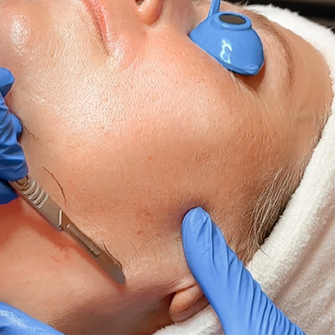 dermaplane-facial-memphis-tn