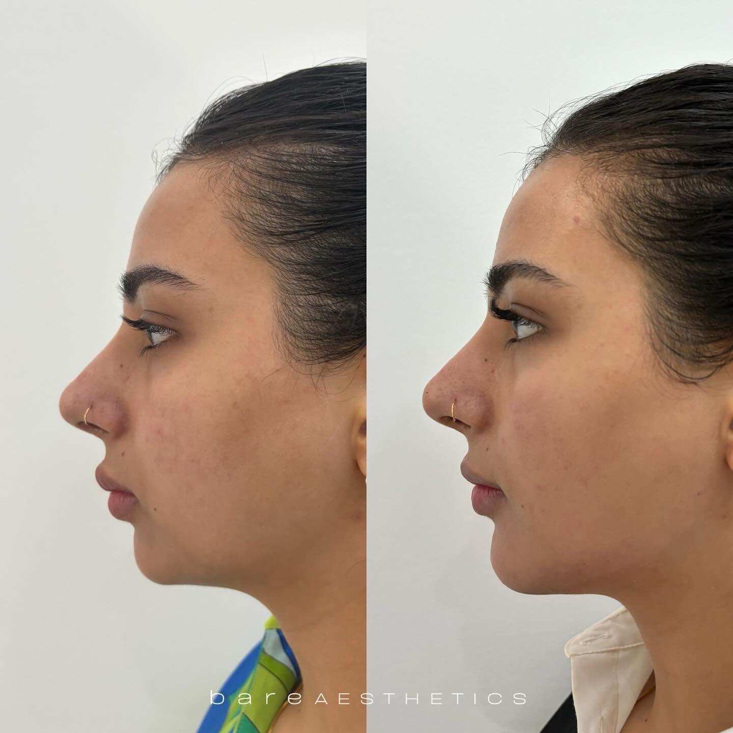 Facial balancing consultation available with AHPRA Registered Nurse Suki. 

Our client&rsquo;s main concerns: 
&bull; Imbalance in her side profile 
&bull; Wanting more jawline definition 
&bull; Migrated lip enhancement (not our work)

Achieved over