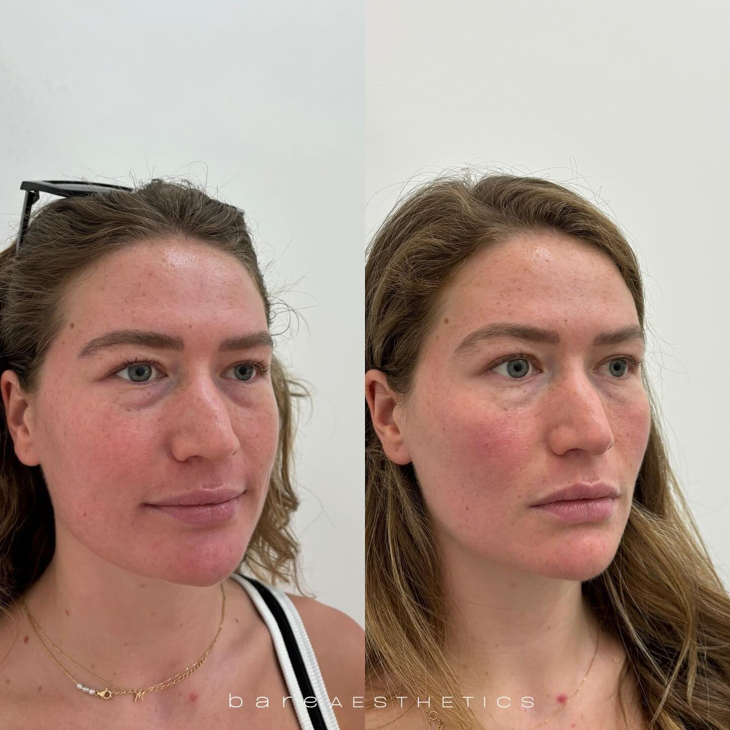 Consultation for skin health, under-eye and volume loss concerns available with AHPRA Registered Nurse Suki. 

Thank you my beautiful client for allowing me to share❤️

Bare Aesthetics&trade; 
Bareaestheticsau.com

𝘋𝘪𝘴𝘤𝘭𝘢𝘪𝘮𝘦𝘳: 𝘋𝘶𝘦 𝘵𝘰 ?