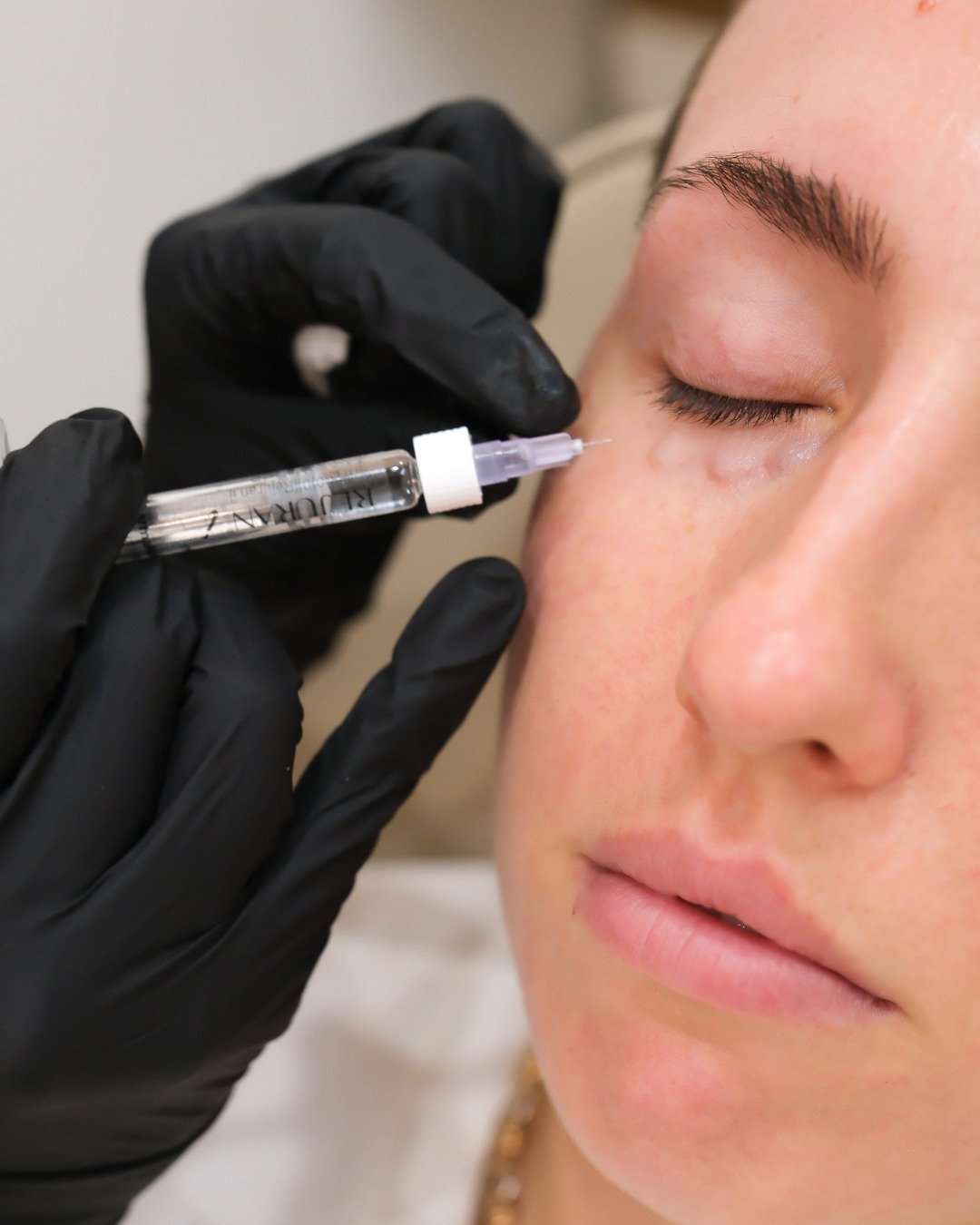 Rejuran works on repairing and regenerating your skin from within. Formulated with polynucleotides (PN) derived from wild salmon DNA and refined through DOT&trade;️ technology, this advanced injectable stimulates collagen, improves elasticity, streng