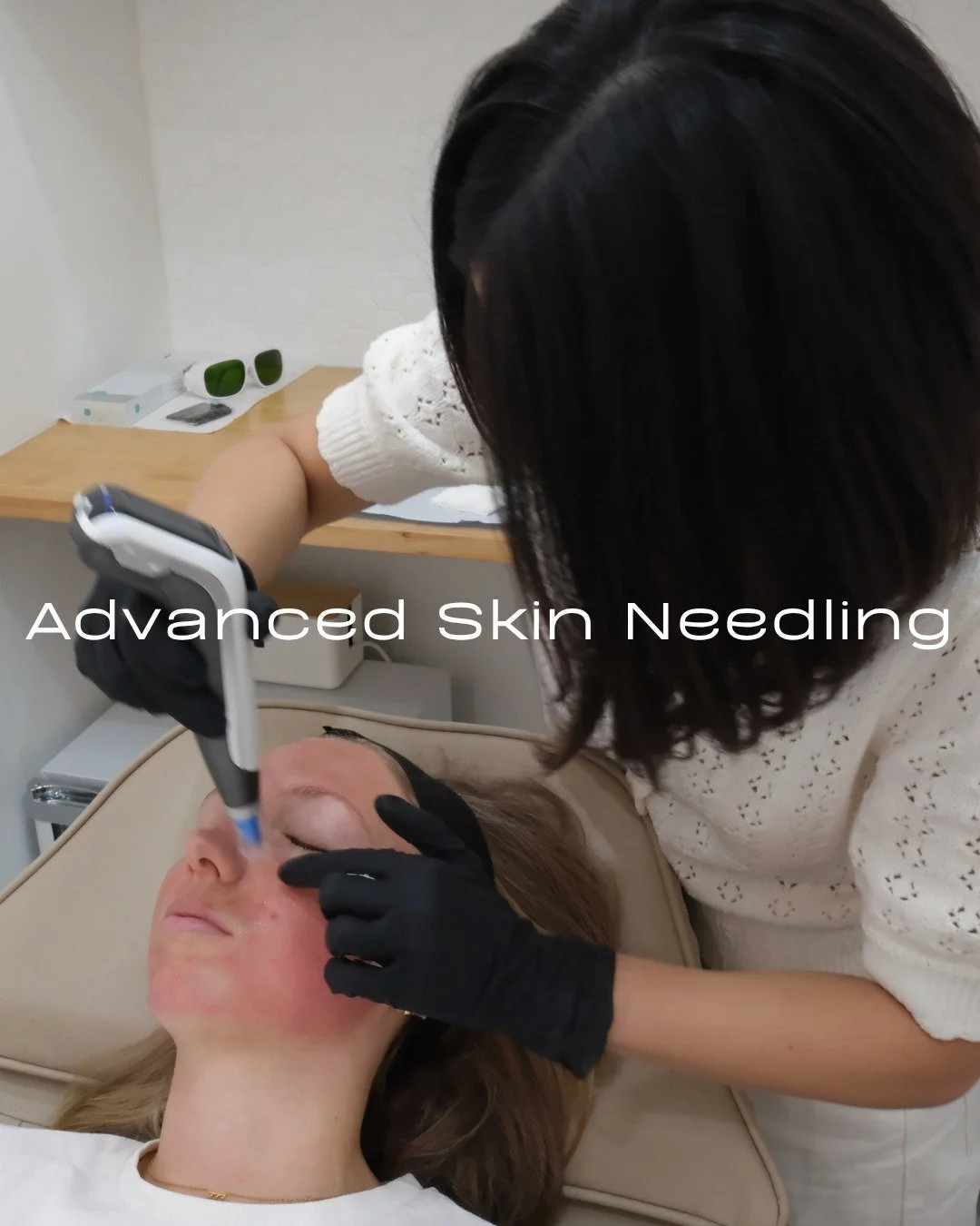 If there is one treatment I would recommend to almost everyone, it is skin needling. 

It is one of those quietly powerful therapies that works with your skin rather than against it, and the results genuinely speak for themselves.

Whether you are de