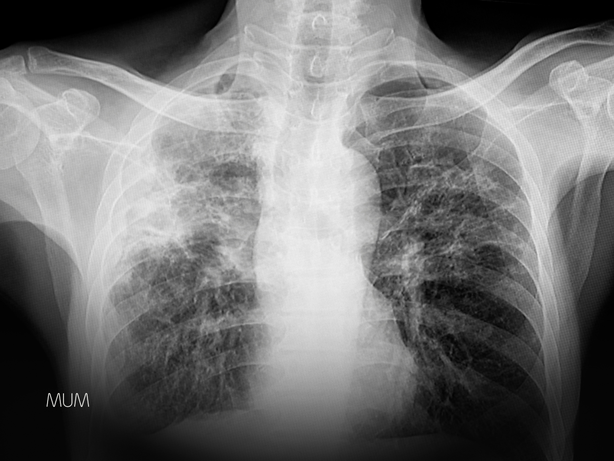 The Modern Guide to Overcoming Tuberculosis: Science, Support, and Survival