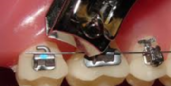 Tips for poking wires — Jump Smile Orthodontics