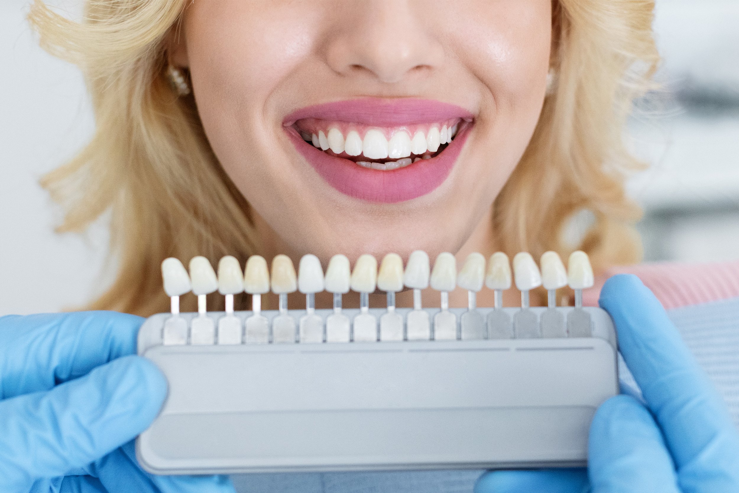 What Are Porcelain Veneers?