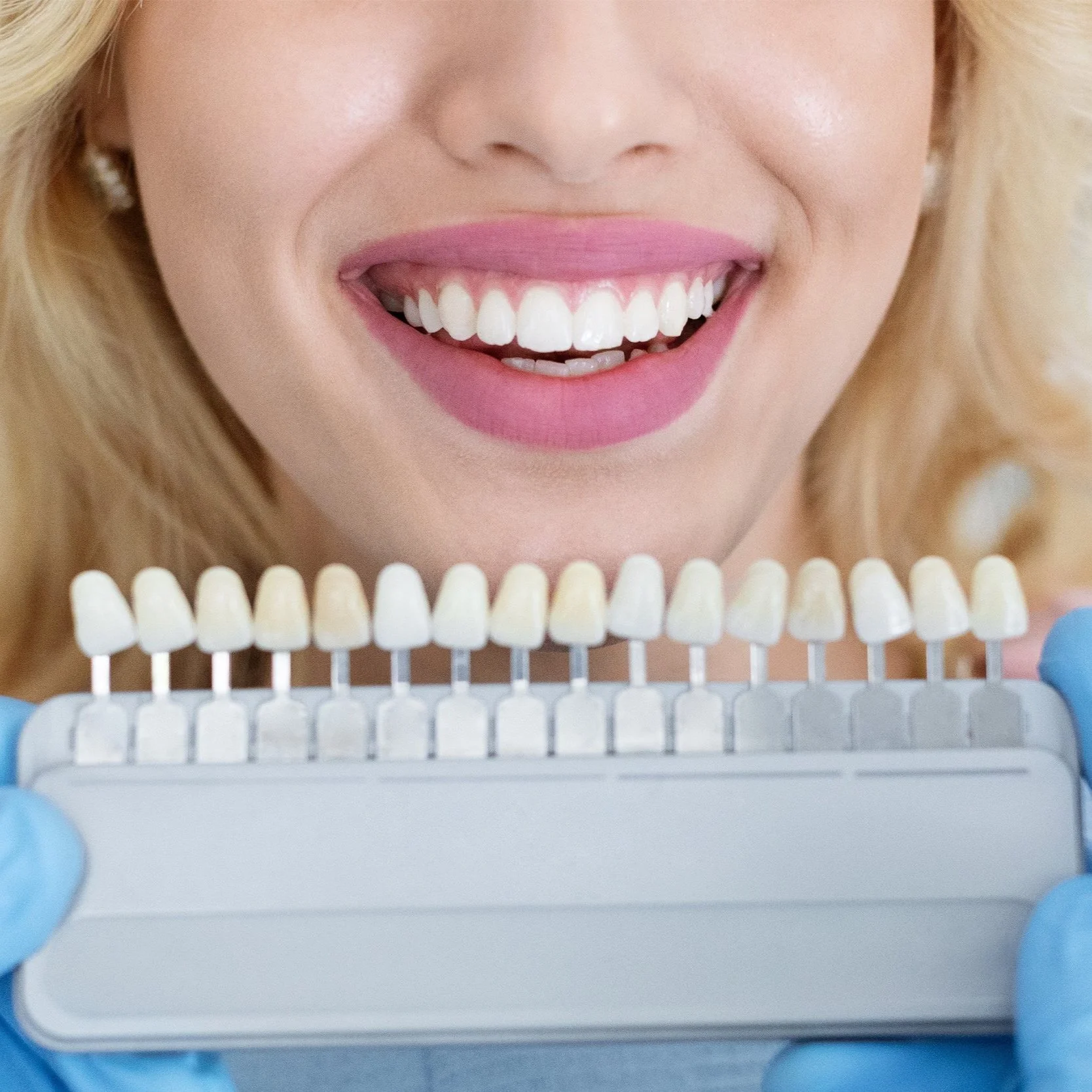 Porcelain Veneers are a popular cosmetic dental treatment that can transform your smile by correcting a range of imperfections. Our skilled team will create custom-made veneers that fit over your existing teeth, enhancing their appearance and improvi