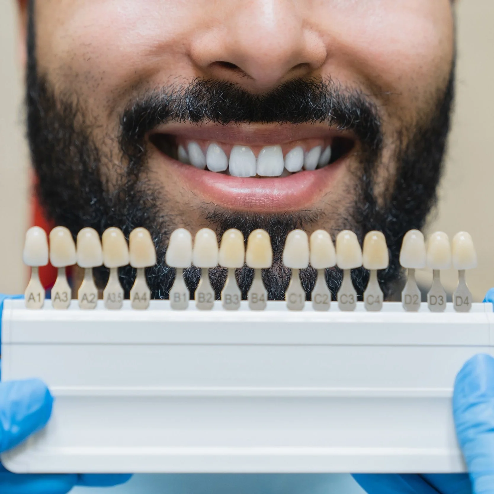 Resin Veneers are a popular cosmetic dental treatment that can enhance the appearance of your smile by correcting a range of imperfections.