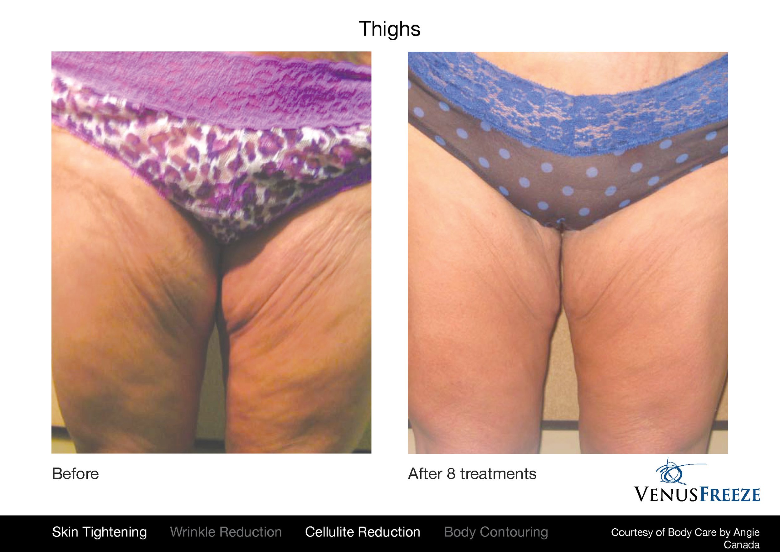 VenusFreeze_BodyCarebyAngie_Thighs_8tx_03.jpg