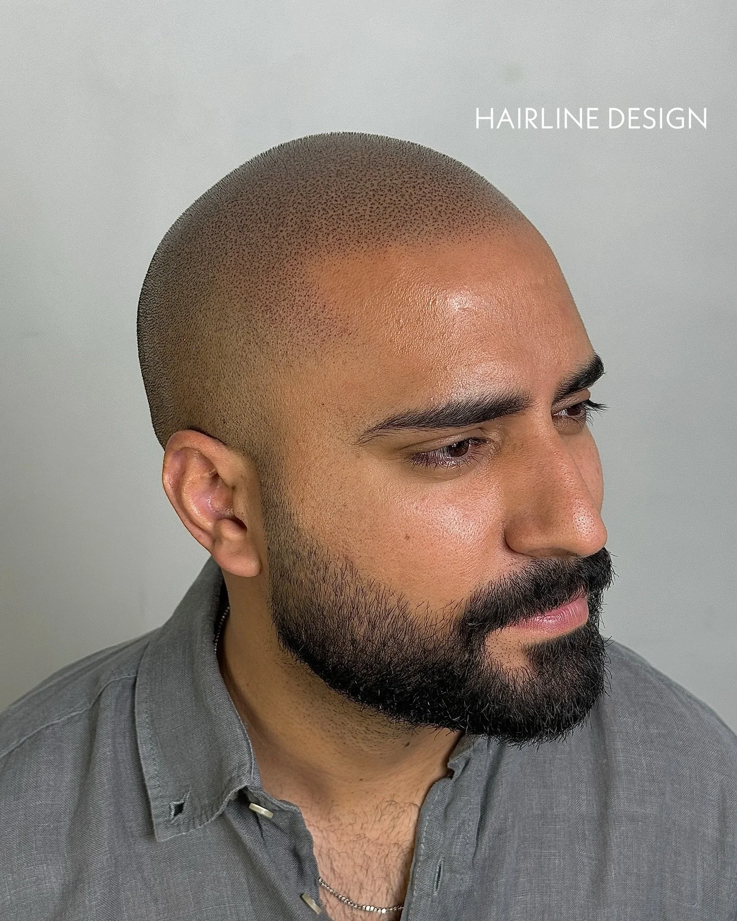 SMP Ladies and Gentlemen. Believe it or not 🤷&zwj;♂️

For a free consultation please call 0585679977 

www.hairlinedesigndubai.com

#smp #smpdubai #scalpmicropigmentationdubai #hairloss #scalpmicropigmentation #hairtransplantdubai #hairlosssolution 