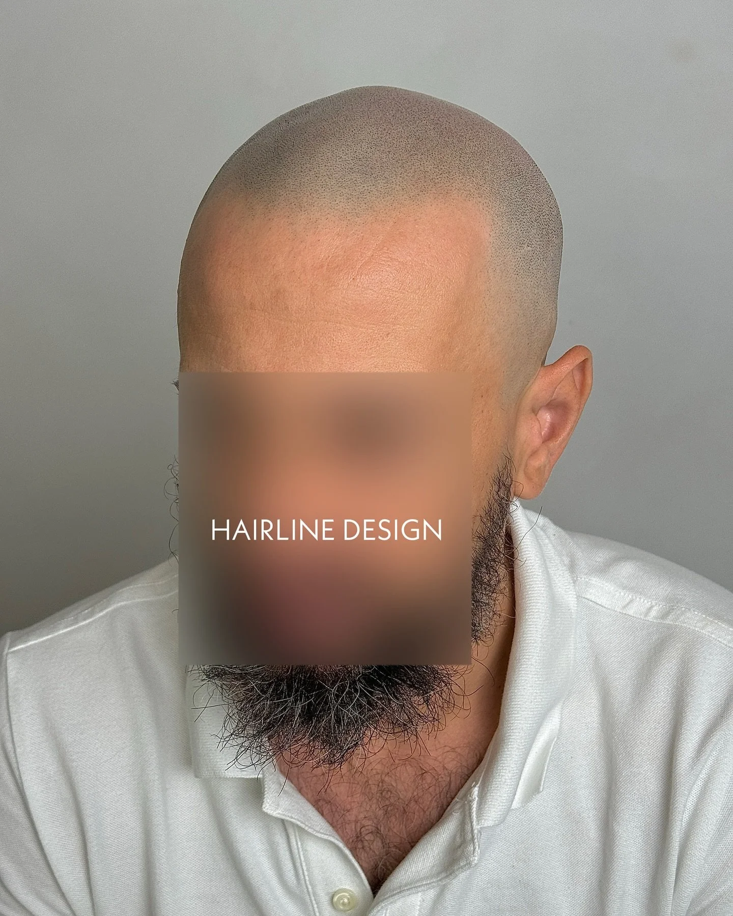 We have the ability to give you a completely natural looking shaved buzz cut 😮&zwj;💨😮&zwj;💨😮&zwj;💨

We will seamlessly fill in any gaps and colour match your natural hair to give you perfect NATURAL looking results. 

Hair or no hair, we can he